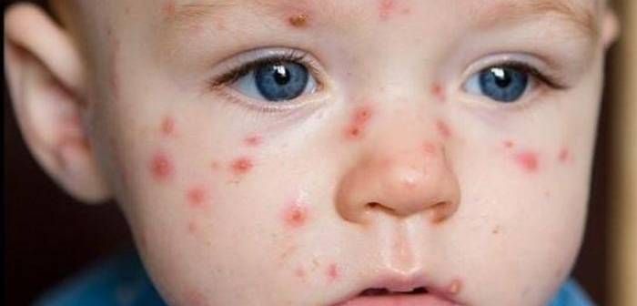 Alte 70 de cazuri noi de rujeolă, confirmate în 16 judeţe, printre care și Giurgiu