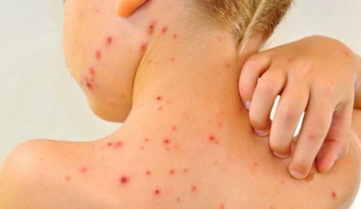 rujeola-1
