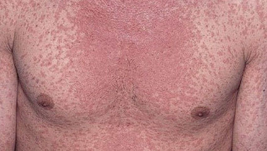 primul caz de rujeolă la Giurgiu